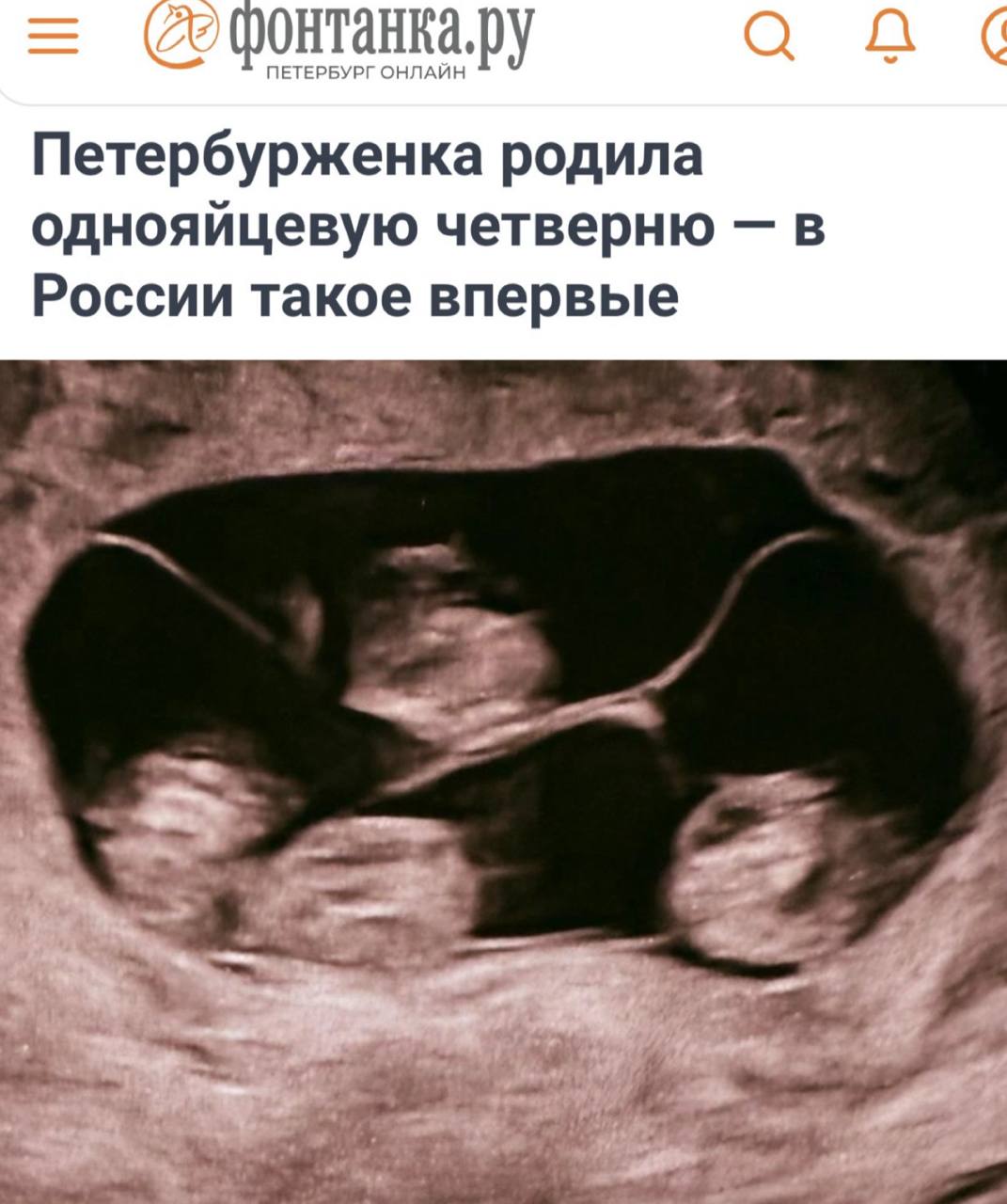 В Петербурге впервые в России родилась однояйцевая четверня