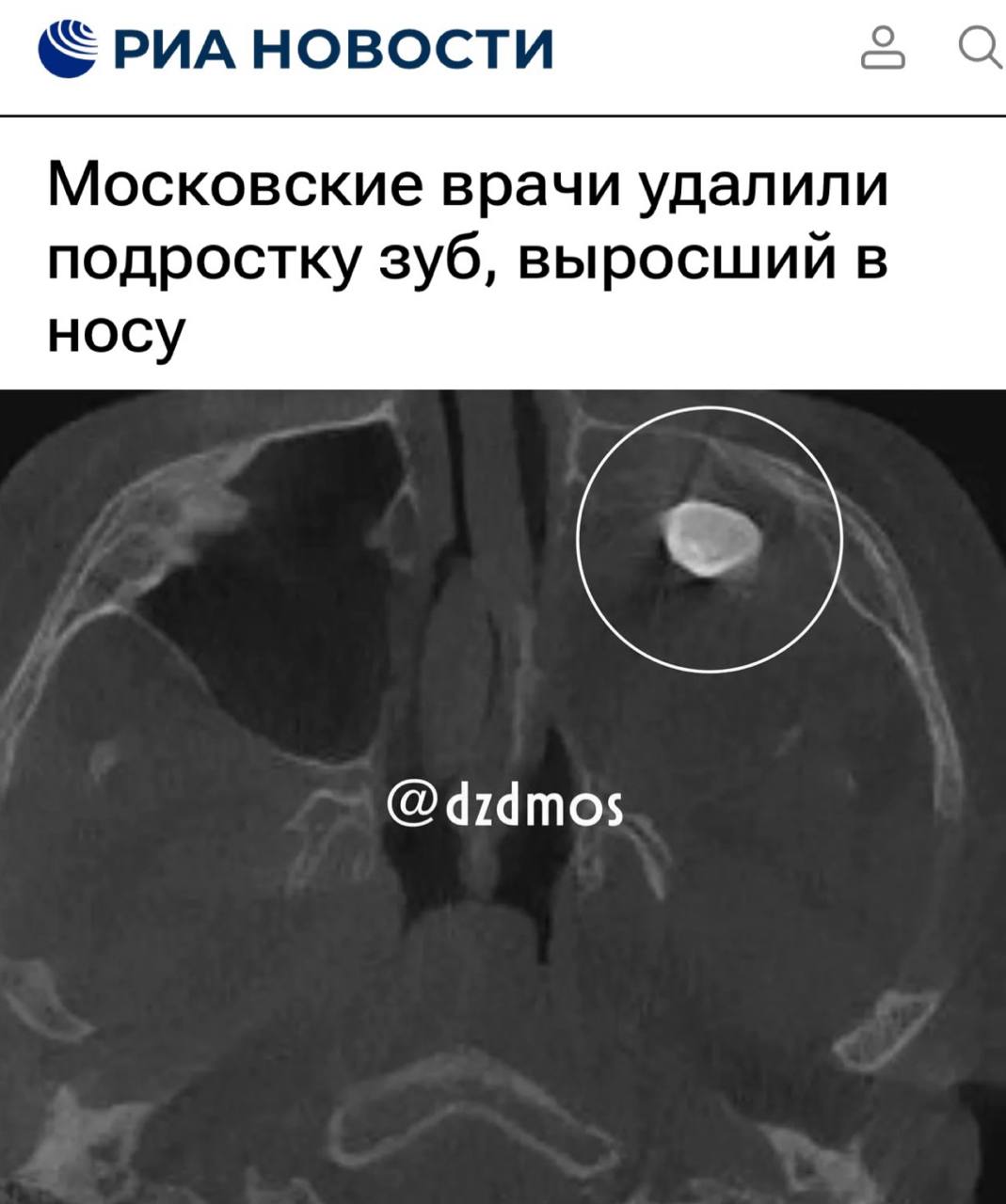 В Москве подростку удалили зуб, выросший в гайморовой пазухе